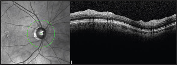 Figure 2. When this line is not visible, the posterior vitreous is totally detached.