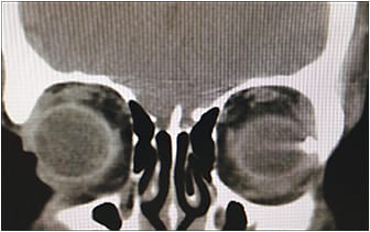 Figure 5. Coronal computed tomography scan demonstrating temporal intraocular foreign body in the left eye.