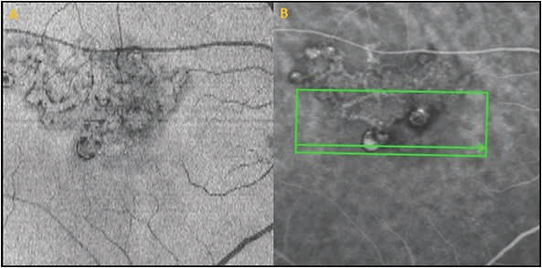 Figure 4. En face optical coherence tomography (OCT) showing a larger lesion size with en face OCT than indocyanine green angiography.