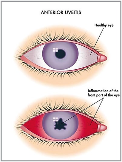 Figure 1: Photo of eye with uveitis