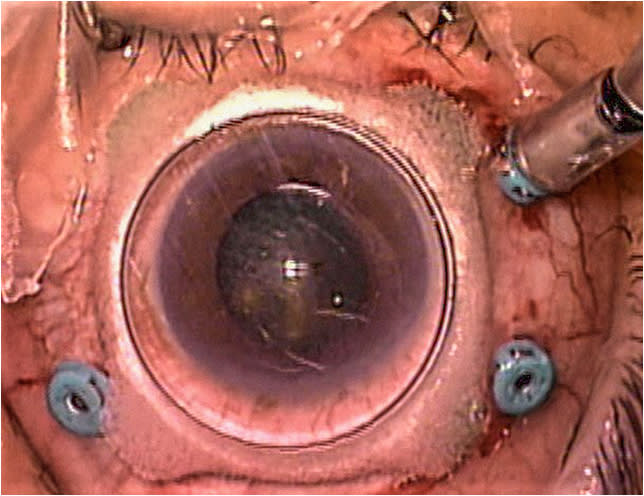 Figure 1. Example of a contact macular lens with stabilizing feet. It is important to center the lens over the cornea to optimize the view.