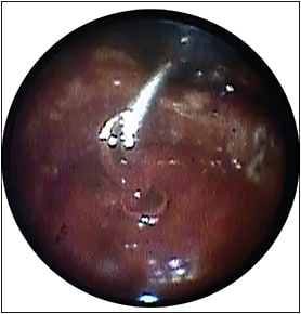 Figure 7. Endoscopic view of silicone oil injection beginning in air filled eye with reattached retina.