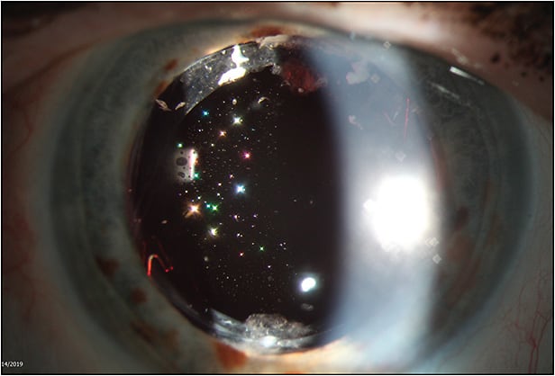 Figure 5. Silicone oil droplets adherent to a silicone intraocular lens after silicone oil removal.