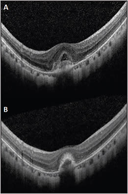 Figure 1. Spectral-domain OCT scans of myopic CNV. Intra- and subretinal fluid associated with an active myopic CNV (A). After treatment with intravitreal anti-VEGF injection, there was complete resolution of both intra- and subretinal fluid. The lesion becomes more compact and the boundary between the lesion and retina becomes apparent. The anterior border of the CNV lesion also demonstrated increased in hyper-reflectivity (B).