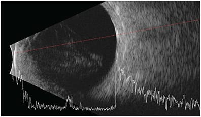 Figure 1. In a patient who presented after surgery for open-globe injury, B-scan ultrasonography revealed a vitreous hemorrhage without evidence of retinal detachment.
