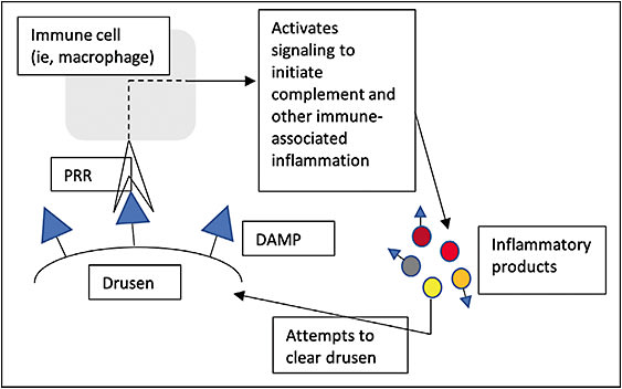 Figure 1. Pattern-recognition receptors (PRRs) on the surface of immune cells recognize damage-associated molecular patterns (DAMPs) within drusen, and this initiates proinflammatory activity intended to clear the foreign body from the surface of the macula. However, some inflammatory activity also presents a DAMP signal that perpetuates additional immune activity, with associated upregulation of inflammation. The end-resulting constitutive inflammation yields off-target cell death of the retinal pigment epithelium, which is yet another source of DAMP signaling and which drives the pathology associated with geographic atrophy secondary to dry AMD.