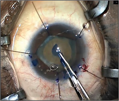 Figure 1. A patient with cataract and nonclearing vitreous hemorrhage. Note the lack of red reflex due to the hemorrhage; staining with trypan blue dye aids in visualization of the anterior capsule.