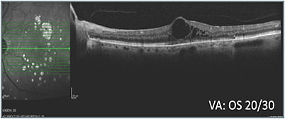 H: Status 18 weeks after treatment class switch OS
