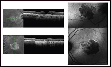 Figure 3. Optical coherence tomography and fundus autofluorescence images from eyes with both geographic atrophy and neovascular age-related macular degeneration on anti–vascular endothelial growth factor therapy. The optical coherence tomography images show choroidal neovascularization responding well to anti–vascular endothelial growth factor treatment, with no signs of exudation, and the corresponding fundus autofluorescence images show extensive central geographic atrophy, accounting for some of the decreased visual acuity in both eyes.
Images courtesy of Carl D. Regillo, MD, FACS