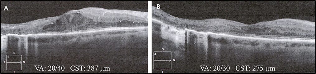 Figure 4. DME demonstrated on OCT prior to dexamethasone injection (A). This patient had failed multiple treatments for DME, including prior grid laser photocoagulation and 4 prior Avastin injections. Approximately 2 months after dexamethasone injection, OCT showed the VA improved and the CST decreased (B). The DME is significantly improved.