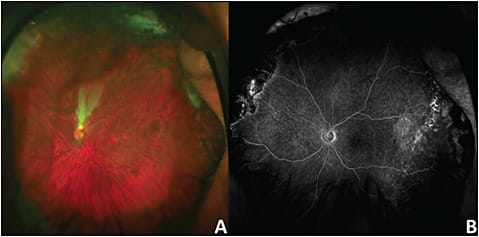 Figure 2. Rhegmatogenous retinal detachment in an adult with myopia and prematurity. Color fundus photo shows development of a stretch hole after scleral buckling with pars plana vitrectomy (A). Fluorescein angiogram shows temporal late vascular leakage (B).