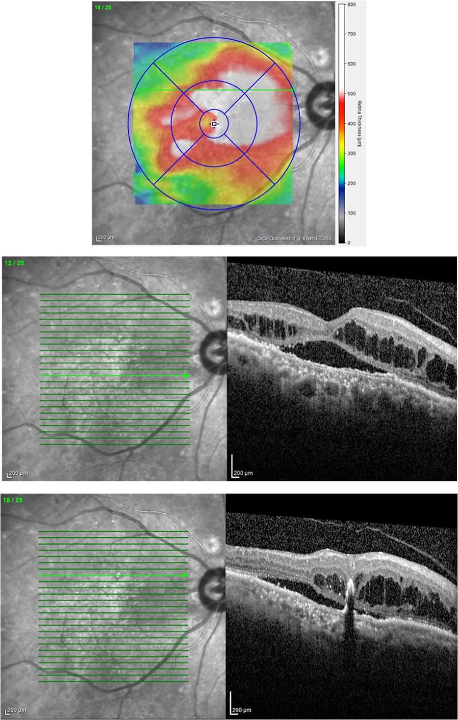 Figure 4. Retinal OCT imaging of a male patient with chronic serous chorioretinopathy identified small extrafoveal pigment epithelial detachment.