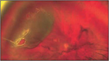Figure. Rhegmatogenous retinal detachment, right eye, with vitreous hemorrhage. Note the retinal tears in the superotemporal vitreous base region, associated with peripheral retinal lattice degeneration.