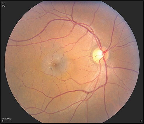Figure 1. Fundus photograph of a 52-year-old male who presented with 3-month history of blurred vision. Vision at exam was 20/40. The macular area shows typical features of macular telangiectasia type 2, including opacification of the retina, presence of retinal pigment epithelial hyperpigmentation, and presence of crystalline deposits.