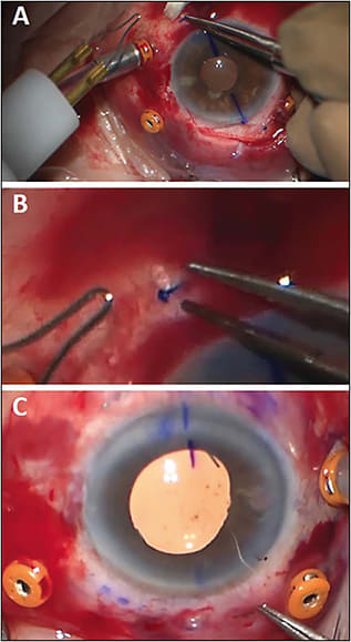 Figure 5. Slightly elevating the haptic and drying the surrounding field with a sponge enables a controlled cautery melt (A). Flanged haptic of a CT Lucia 602 IOL (Carl Zeiss Meditec) (B). Use tying forceps to tuck the haptic ends into the scleral tunnel covered by conjunctiva (C).