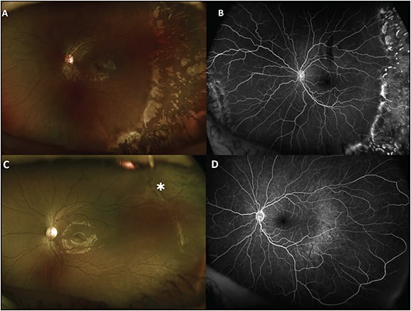 Figure 1. Regressed retinopathy of prematurity (ROP) after treatment by photocoagulation or intravitreal injection (IVI) of anti-VEGF. An 8-year-old patient with posterior zone 2, type 1 ROP was treated by laser photocoagulation (A). Atrophic retinal tissue and diffuse pigmentary changes in the periphery were observed. Although some vessels continued to grow over the lasered area, most of the retinal vessels were destroyed by the laser in the ablated zones (B). A 6-year-old patient previously with zone 2, stage 3 ROP with plus disease were treated with anti-VEGF. The regressed fibrotic ridge (asterisk) and retinal pigment epithelial alterations were observed (C). Looping vessels were visualized well by wide-field fluorescein angiography (D).
