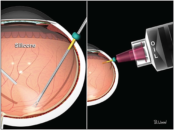 Figure 2. Epimacular forceps membrane peeling “under” oil using an Alcon DSP ILM forceps. IMAGE CREATED BY BYRON WOOD, GRAPHIC DESIGNER AND MEDICAL ARTIST WITH CHARLES RETINA INSTITUTE.