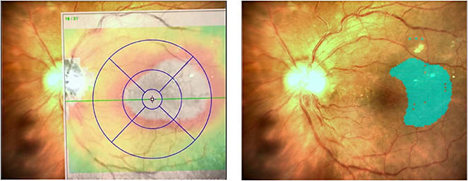 Figure 2. The laser treatment plan involved 855 spots delivered at an average power of 97.94 mW, average pulse duration of 100 ms, and average spot size of 100 µm, with duty cycle 15%. The total energy applied was 0.4357 J.