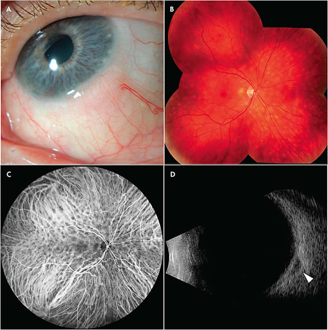 Figure 2. A 52-year-old male presented to an outside center with a perilimbal conjunctival salmon patch (A). Biopsy confirmed low-grade extranodal marginal lymphoma and the patient received low-dose (total 4 Gy, 2 fractions of 2 Gy each) external beam irradiation. One year later, he was referred to our center with multiple amelanotic lesions in the choroid (B). Indocyanine green angiography highlighted areas of decreased uptake due to the clinically observed space-occupying infiltrates in the choroid (C). B-scan ultrasonography revealed a low-reflective episcleral mass near the optic nerve (D).