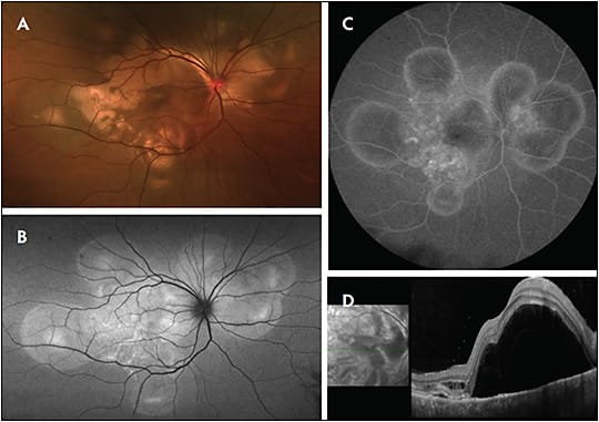 Figure 3. Ultrawidefield fundus image of a patient with Vogt-Koyanagi-Harada disease (A) shows multiple serous retinal detachments. The circular areas of hyperautofluorescence correspond to the areas of serous retinal detachment (B). Fluorescein angiography is notable for pinpoint leakage and pooling of fluorescein dye (C). Optical coherence tomography reveals a large serous detachment involving the macula (D).