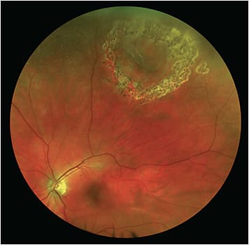 Figure 4. Six-month follow-up of a symptomatic retinal tear treated with retinopexy. Note the treatment of the anterior margin of the tear.