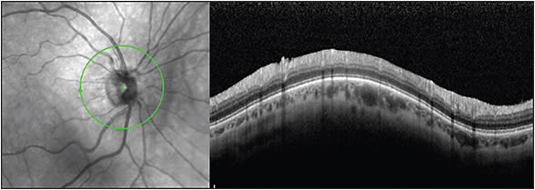 Figure 3. A Weiss ring was not visible on examination, and on OCT imaging, the line that would indicate presence of a still attached posterior hyaloid to the ONH is not visible, indicating a complete PVD.