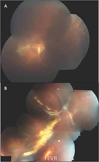 Figure 1. Imaging of a patient with familiar exudative vitreoretinopathy showing dragging of the macula, vitreous traction and peripheral laser (A). Familiar exudative vitreoretinopathy with dragging, exudation, and a tractional retinal detachment (B).