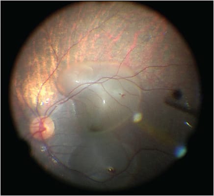 Figure 2. Multiple subretinal blebs may be necessary for a therapeutic dose of gene vector.