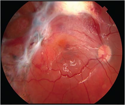 Figure 1. Postoperative month 2, a fundus photograph showing proliferative vitreoretinopathy along the superior arcade following repair of rhegmatogenous retinal detachment and removal of retained intraocular foreign body.