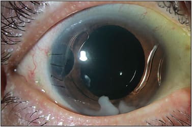 Figure 1. Residual lens cortical material in the anterior chamber abutting the cornea after anterior vitrectomy and placement of an anterior-chamber intraocular lens.
IMAGE COURTESY ALEKSANDRA RACHITSKAYA, MD