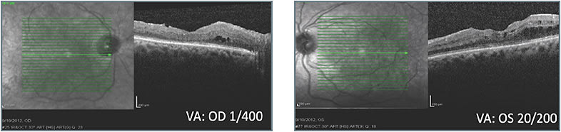 B: Status 1 month after first treatment with different class of therapy