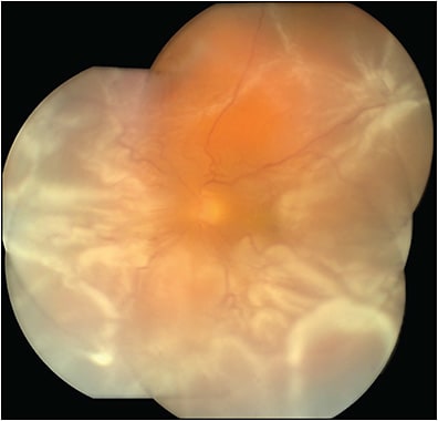 Figure 2. Recurrent retinal detachment after silicone oil removal in a patient with retinal detachment with proliferative vitreoretinopathy.
