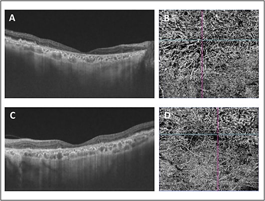 Figure 1. Optical coherence tomography (OCT) and OCT angiography images (Triton; Topcon) of a case of advanced age related macular degeneration with geographic atrophy.