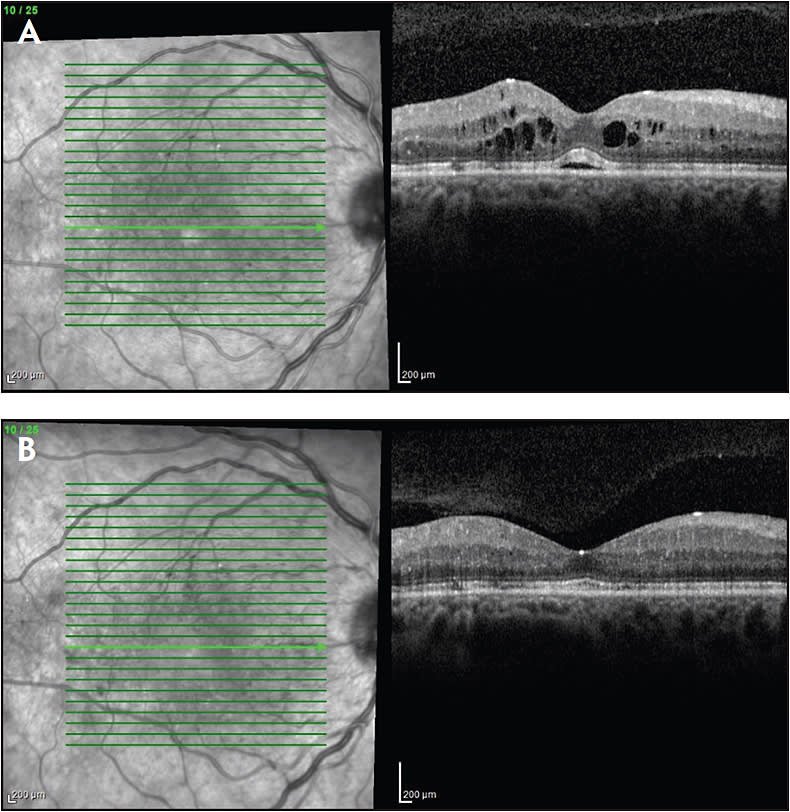 Figure 2. A 32-year-old female with type 1 diabetes mellitus presented after having been lost to follow-up for several months. She had chronic DME but had been noted previously to respond well to ranibizumab at 2-month intervals. VA was 20/40 OD. SD-OCT OD revealed center-involved DME with subretinal fluid. CST was 368 µm. The patient was counselled regarding the importance of optimal control of blood glucose, serum lipids, and blood pressure and was treated with ranibizumab (A). The patient returned for follow-up 2 months later. She noted no changes in symptoms. VA improved to 20/30 OD. SD-OCT OD revealed improved macular edema and subretinal fluid. CST improved to 259 µm (B).