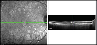 Figure 2. Imaging with EDI-OCT shows pigment epithelial detachment demonstrating increased hyper-reflectivity within PED on the back surface of the RPE, indicative of choroidal neovascular membranes.