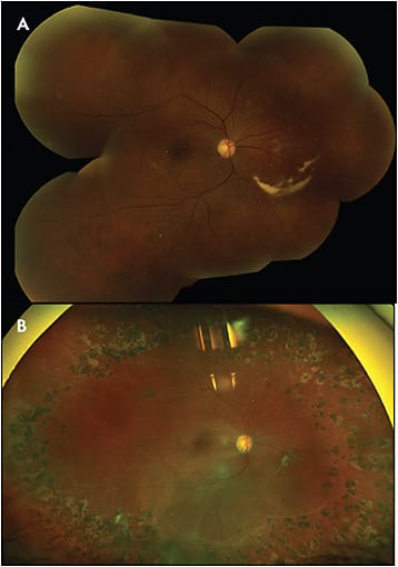 Figure 2. A 47-year-old female with early proliferative diabetic retinopathy (A) underwent panretinal photocoagulation and then was lost to follow-up for 1 year. Optos imaging (B) shows new subretinal fluid and development of a tractional retinal detachment on return.