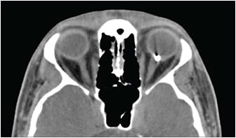 Figure 6. Axial computed tomography scan indicating posterior intraocular foreign body in the eye.
