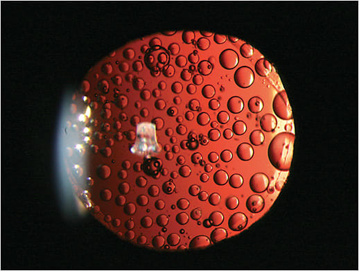Figure 1. Emulsified silicone oil droplets seen in the posterior chamber and on the intraocular lens.