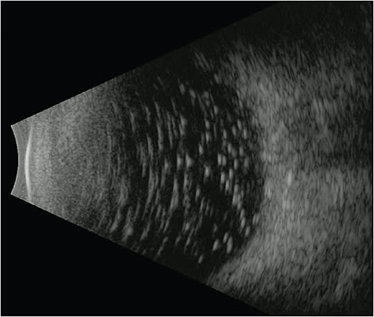 Figure 4. B-scan ultrasound of emulsified oil after silicone oil removal. Small oil droplets remained after multiple fluid-air exchanges.
