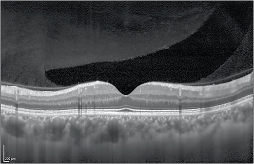 Image of a healthy retina obtained using the OCT2 module. COURTESY OF HEIDELBERG ENGINEERING