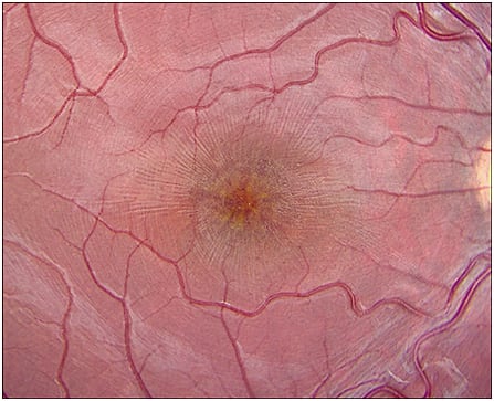 Figure 1. Fundus photo of right eye, showing foveal schisis in a stellate pattern.