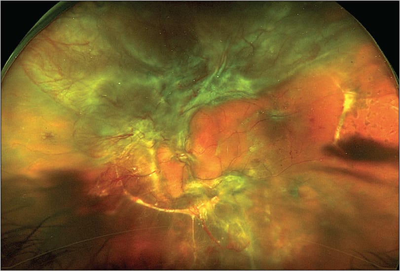 Figure 2. Wide-angle Optos photo of the left eye of the same patient as Figure 1. A total longstanding tractional and rhegmatogenous retinal detachment is present with very vascular fibrovascular proliferation extending to the periphery in the superior retina. Thick subretinal membranes are seen under the temporal and nasal retina. Visual acuity was light perception. The patient underwent 27-gauge vitrectomy with preoperative bevacizumab injection and silicone oil tamponade. Anatomic retinal reattachment was achieved, but the best corrected visual acuity was counting fingers 2 weeks postoperatively.