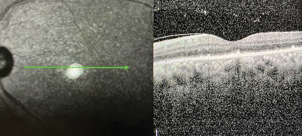 Figure 3. Optical coherence tomography demonstrating vitreous cells, pyramidal deposits, and disruption of outer retinal layers.