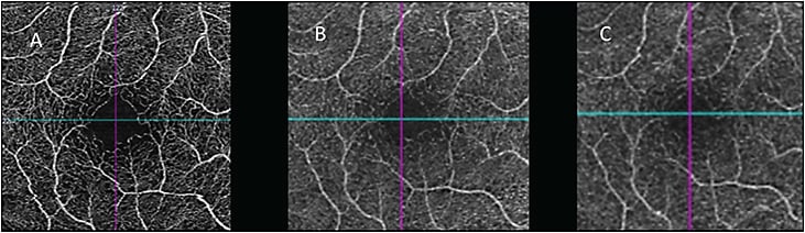 Figure 2. The Zeiss Cirrus 5000 Angioplex offers a 3 mm x 3 mm scan pattern (A), a 6 mm x 6 mm scan pattern (B), or an 8 mm x 8 mm scan pattern (C). The resolution decreases as the scan pattern enlarges. All 3 images show the central 3 mm x 3 mm retinal vascular flow, as acquired by the 3 mm x 3 mm, 6 mm x 6 mm, and 8 mm x 8 mm scan patterns.