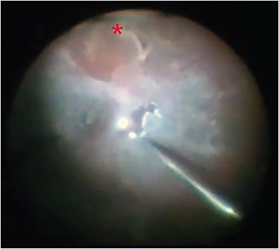 Figure 1. Rhegmatogenous retinal detachment with incomplete posterior vitreous detachment (PVD). Clinical preoperative examination had documented a PVD and Weiss ring. Chromovitrectromy with triamcinolone shows the posterior hyaloid is separated in the quadrant with the primary retinal break (inferiorly at the red asterisk) but persists in areas of attached retina.