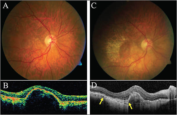 Figure 4. A 70-year-old female with RPE tear. The patient has history of non-nAMD and presented with worsening vision in OD after uncomplicated cataract surgery. BCVA was 20/100, and exam was consistent with soft drusen (A) and associated serous PED (B). The patient underwent multiple intravitreal injections of bevacizumab and, 4 years into the course, she developed an RPE tear, observed as an area of rolled-up hyperpigmented RPE juxtaposed to the lighter pigmented area without RPE (C). SD-OCT demonstrated an abrupt discontinuity of the RPE layer at the site of the rip (D, yellow arrows).