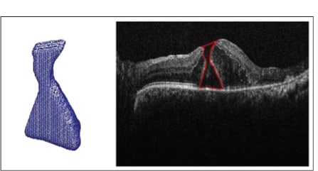 Figure 3. Macular hole segmentation with three-dimensional reconstruction. A volumetric segmentation algorithm allows for quantitative comparison of subtle intraoperative changes in macular hole geometry.3,8