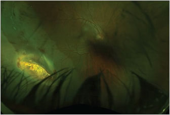 Figure 4. Fundus photo demonstrating inferotemporal large metal intraocular foreign body embedded in the retina of the right eye with an associated retinal detachment.