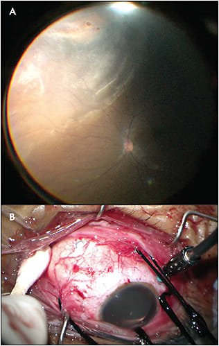 Figure 3. A 23-year-old phakic female with a macula-sparing inferonasal retinal detachment underwent repair with a chandelier scleral buckle. With visualization using a noncontact wide angle viewing system and a chandelier in the inferotemporal quadrant, scleral depression in the inferonasal quadrant highlighted one of the clusters of causative breaks (A). An external view demonstrates marking of the posterior-most break and the location of the chandelier approximately 90 degrees away (B). Cryotherapy was applied with chandelier visualization to all causative breaks. This patient had 360 degrees of lattice degeneration, and an encircling band was placed with resolution of the detachment.