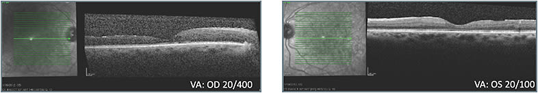 C: Status 1 month after second treatment with different class of therapy